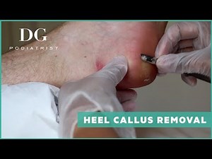 Heel callus removal: Mild