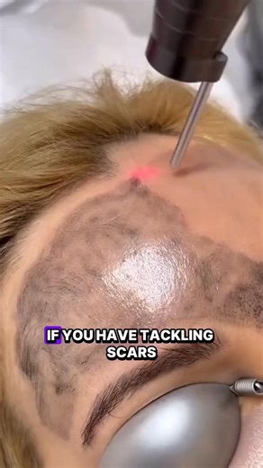 Understanding Laser Skin Treatments: Cost, Benefits, and Options | Professional Service | Facebook