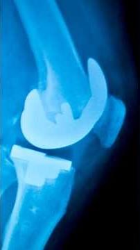 Knee replacement surgery explained