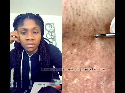 Blackheads 2021 newest dr pimple popping videos Ep 13