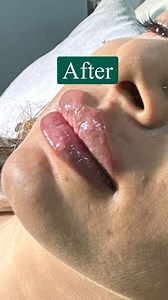 4.5K views · 15 reactions | Lip Filler before after #lipfiller | Sedona Aesthetic Derma & Laser Center | Facebook