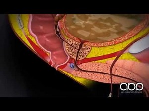 Prostate Cancer (Labelled) - 3D Medical Animation || ABP ©