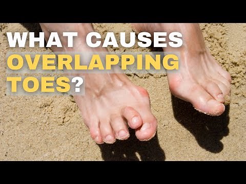 Overlapping Toes: Causes and Solutions