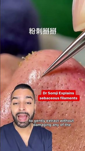 sebaceous filaments nose extraction | Dr. MediSpa