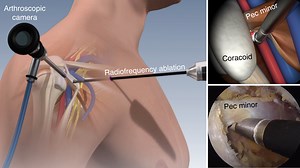 Pectoralis Minor Syndrome: A Relatively Unknown Condition with a Somewhat Simple Solution - Shoulder & Elbow