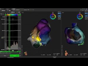 Reveal With OPAL: Critical Isthmus LUMIPOINT™ Identification