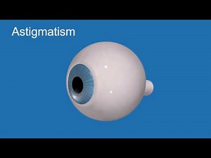 Astigmatism