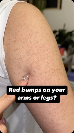 1.4M views · 3.5K reactions | Noticing tiny red bumps on your arms or...