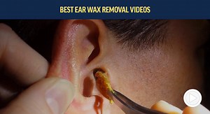 Best Ear Wax Removal Videos