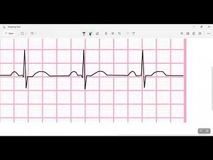 Heart rate calculation: 300 Method