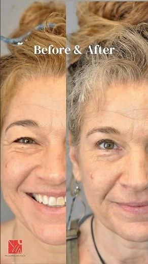 Before and After Upper Eyelid Surgery (Blepharoplasty) | Dr. William Numa | Boston | #beforeandafter