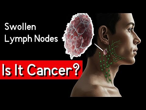 Swollen Lymph Nodes? - Lymphadenopathy. When to Worry and What It Means for Your Health!
