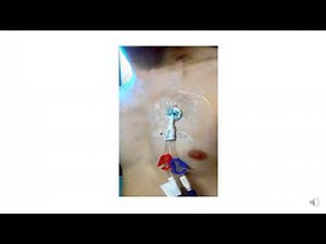 Central Venous Catheters