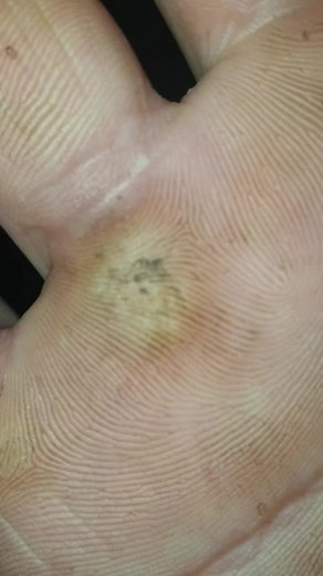 ingrown hair removal satisfying dr pimple popper#ingrownhair #remove #hair #pumpil