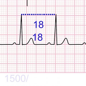 How to Calculate Heart-Rate from ECG - Learn more at http://buff.ly/2pmhXN4 | ECG Teacher