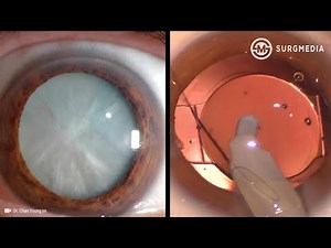 Step by Step Cataract Surgery: From Start to Finish