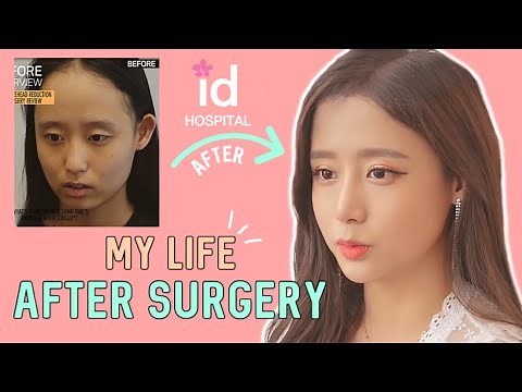 Forehead Reduction l Hairline Lowering Surgery Review at ID Hospital Korea