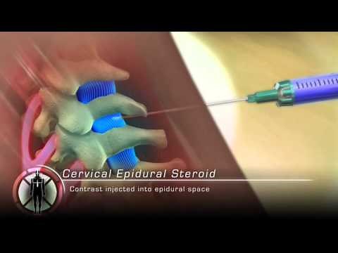 Cervical Epidural Steroid Injection Procedure Animation