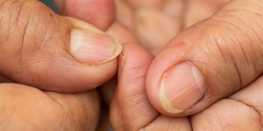 When Yellow Nails Are Normal—and When They’re Not, According to Derms