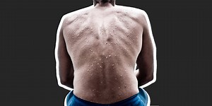 How To Get Rid of Back Acne For Good, According to an Expert