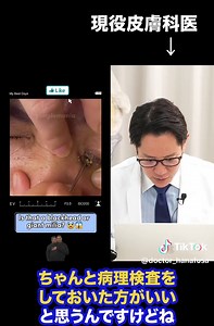 ジャイアントコメドの病理検査必要性 | 皮膚科医のアドバイス