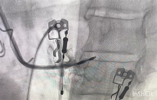 Performed LOT-CRT-D (Left Bundle Optimized Cardiac Resynchronization Therapy with Defibrillator)Recently managed a case of LBBB with a wide QRS of 180 ms, NYHA Class III symptoms, and severe LV… | Dr Ankur Gautam 🇮🇳