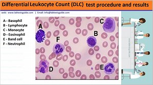Differential Leukocyte Count (DLC) Test Procedure | Lab Tests Guide