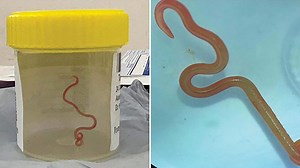 Doctors find a live, 8 cm worm in Australian woman's brain