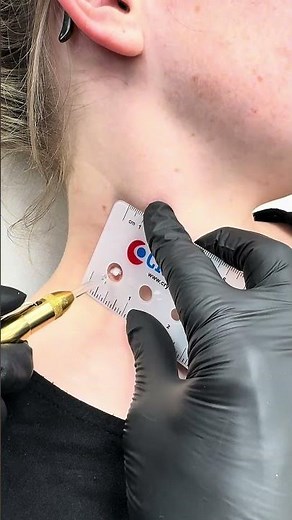 Watch Skin Tag Removal with Cryotherapy: Dr. Javed’s Freezing Technique!