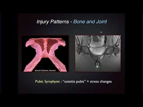 Imaging of Groin Pain: Athletic Pubalgia