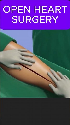 OPEN HEART SURGERY