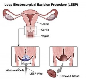 LEEP Procedure Brooklyn | Loop Electrosurgical Excision Procedure in NYC