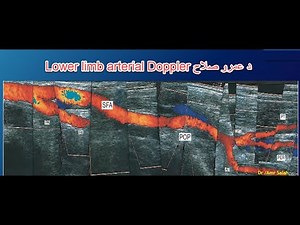 Lower limb arterial Doppler ( How to Do) - practical case د عمرو صلاح