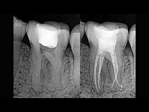 Root canal treatment of the lower mandibular first molar