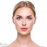 Thread Lift | FAQs   Before & After | Injectable Aesthetics