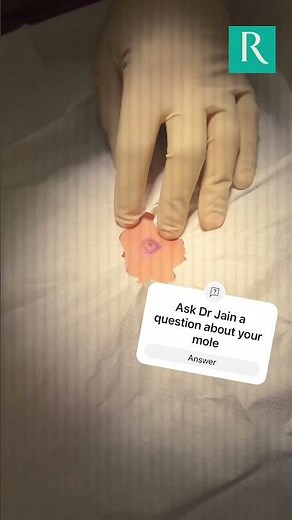 Witness the Mole Removal Process with Punch Biopsy!