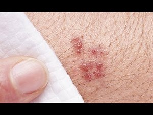 The Basics: What You Should Know About Shingles