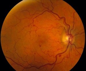 Central Retinal Vein Occlusion, CRVO Treatment, CRVO Causes