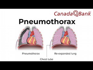 Pneumothorax Explained | Types, Causes, Diagnosis & Emergency Management | CanadaQBank