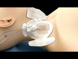 3M™ PICC/CVC Securement Dressing Application Video