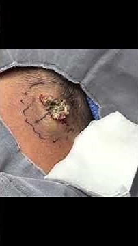 Pretty standard epidermoid cyst squeeze on the back of the neck.