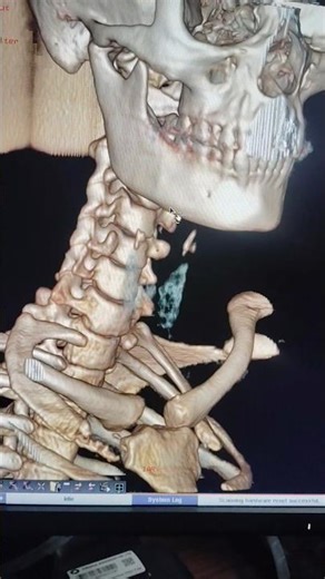 Ct Scan Neck 3D #shorts #shortvideo #ytshorts #medical#motivation