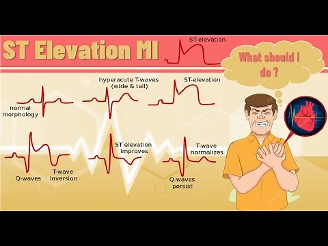 ST elevation myocardial infarction -STEMI | ST elevation MI pathophysiology, ECG finding and example