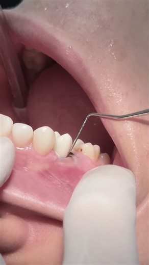 Rebuild badly decayed upper first premolar after root canal treatment #dentist