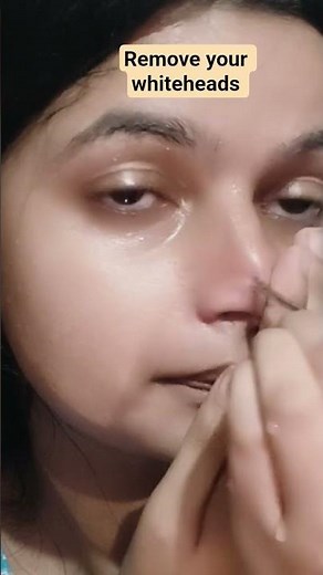 " remove whiteheads safely at home / one time a week routine "