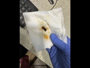 Cerumen Impaction Removal Irrigation Method Courtesy Martha Roberts NP and Rebecca Grant NP