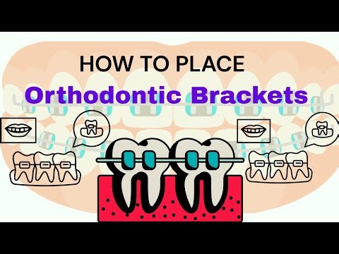 Step-by-Step Bracket Bonding | Clinical Demonstration 🎥