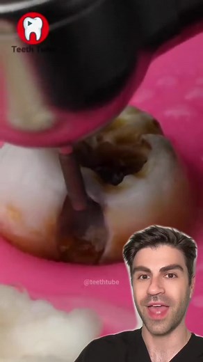 Fixing a HUGE cavity #dentist #tooth #teeth #filling #toothfilling | filing teeth