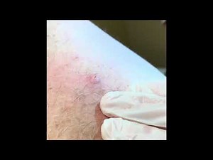Exploding blackhead part 2