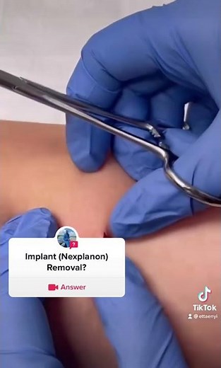 Nexplanon Implant removal. MEDICAL ADVICE